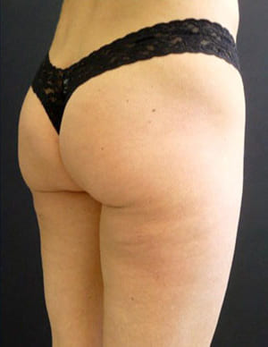 антицеллюлитный массаж