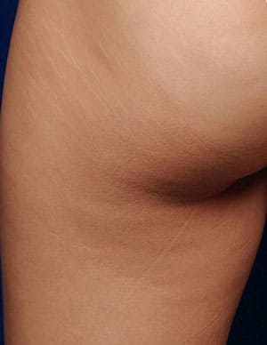 антицеллюлитный массаж