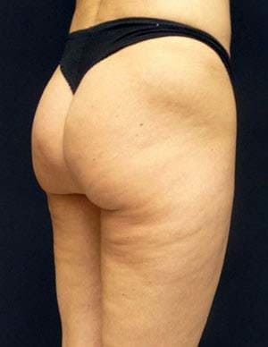 антицелюлитный массаж в нащем массажном кабинете