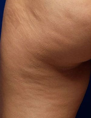 антицелюлитный массаж в нащем массажном кабинете