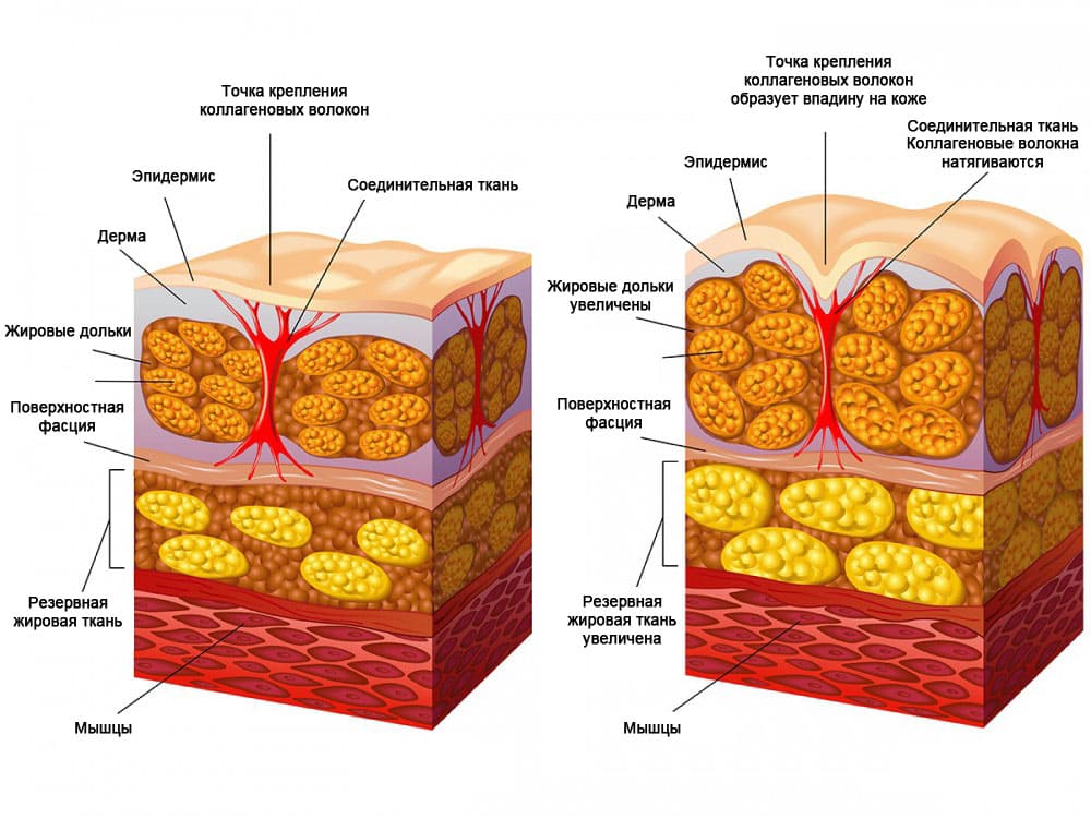 появление целлюлита