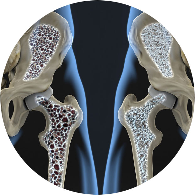 массаж при остеопорозе