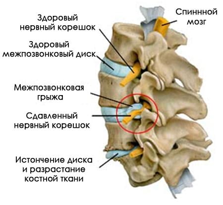 Массаж при остеохондрозе в спб