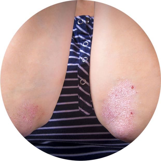 массаж при псориазе