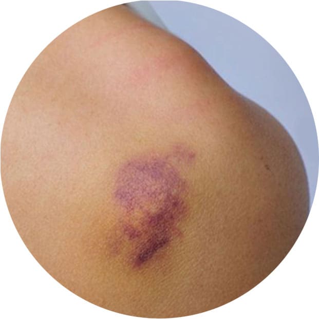 массажа и синяки