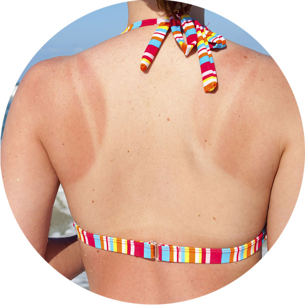 массаж при ожогах