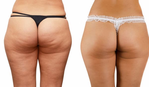 массаж и целлюлит