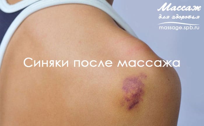 синяки после массажа